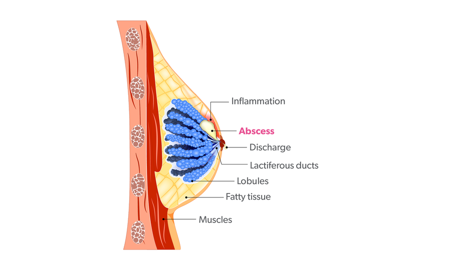 abscess-diagram-breast-conditions.png
